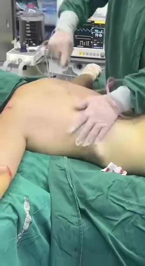 卧槽！这是什么手术？这不得青一块紫一块的 #医美 好吓人 ！（视频 1/1）